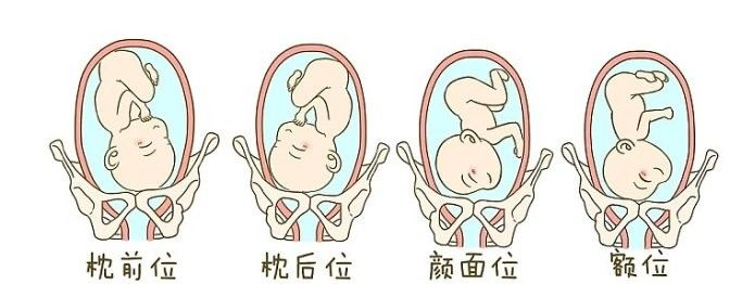深圳鸣鹿中医诊所：胎位不正灸至阴