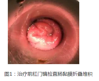 福建省第二人民医院：（医案）中医如何治疗直肠黏膜脱垂