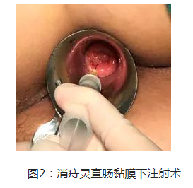 福建省第二人民医院：（医案）中医如何治疗直肠黏膜脱垂