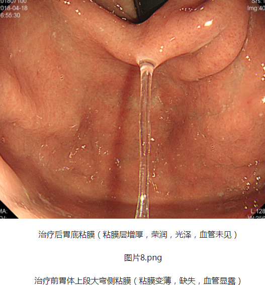 福建省第二人民医院：（医案）中医如何治疗慢性胃炎