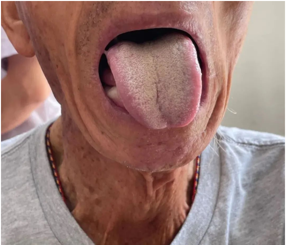 肝癌舌头图片症状图片