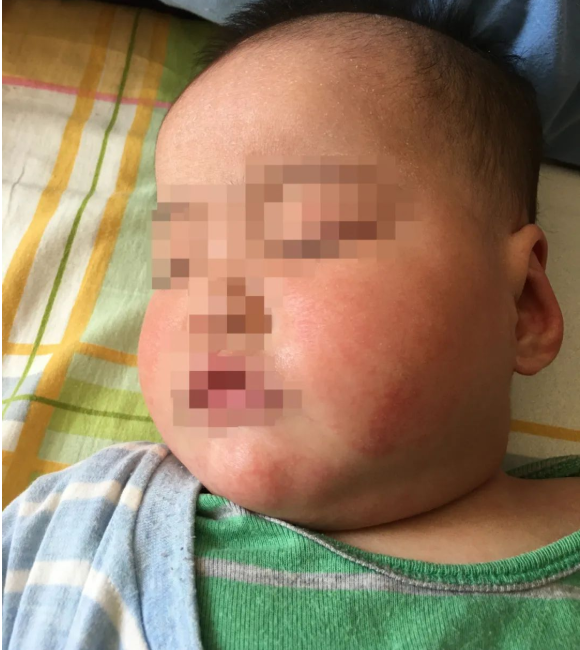 深圳问止中医门诊部：王丹丹调理婴儿的胎毒与皮肤瘙痒