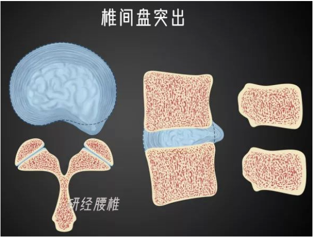 深圳正曲脊柱中医诊所：腰痛怎么办？