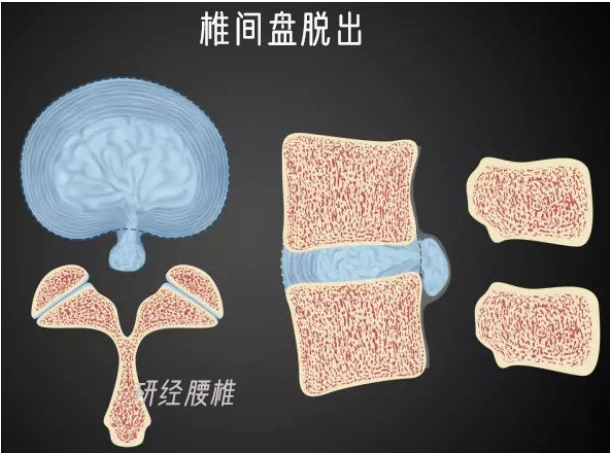 深圳正曲脊柱中医诊所：腰痛怎么办？
