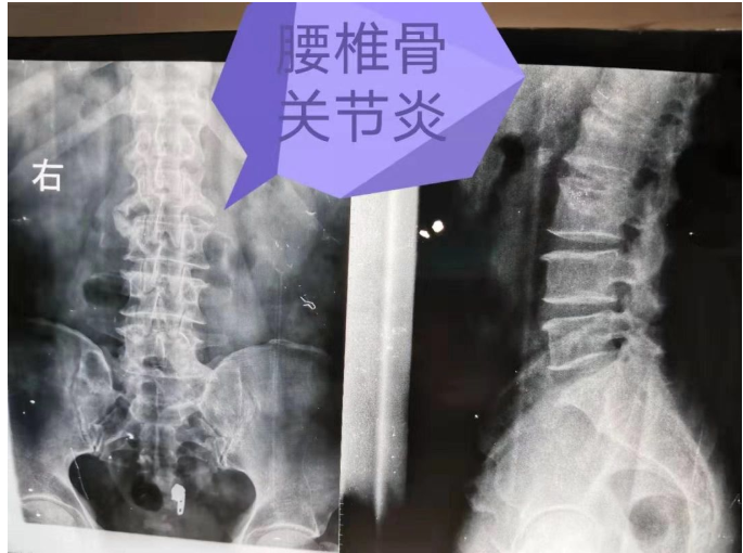 郑州德馨中医院：正骨、筋骨针治疗腰椎间盘突出并椎管狭窄症
