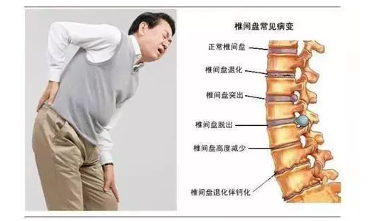 郑州宗黄堂良医馆：腰疼就是腰肌劳损了？