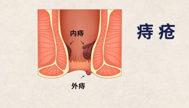 武汉博仕中医肛肠医院：同样都是痔疮，为什么症状会不一样？