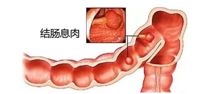 武汉世纪国医堂医院：来看看一枚小息肉，“养”在肠道里4年会变成什么样子？