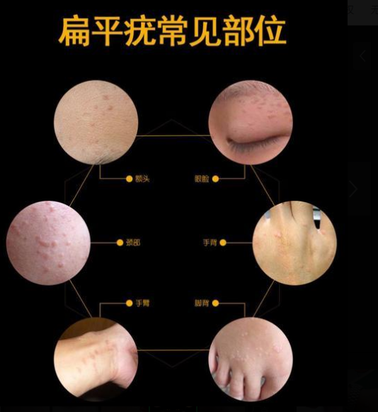 武汉太医堂中医院：扁平疣的五大误区！你都了解吗？