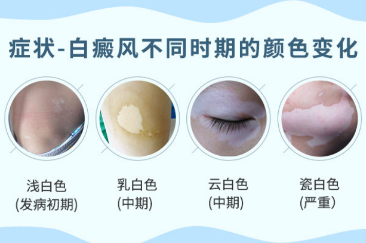 武汉环亚中医白癜风医院：白癜风患者夏季如何防晒，这几个小妙招教给你!