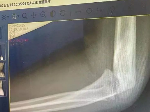 上海三爱中医门诊：（医案）中医如何治疗小儿粉碎性关节骨折