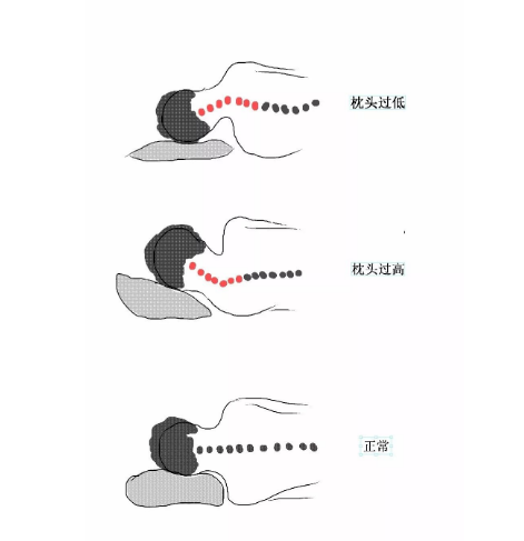 武汉贝莱中医医院：椎间盘突出能按回去吗？枕头高度怎么选？