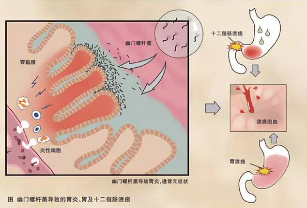 武汉贝莱中医医院：幽门螺杆菌是如何赖上了你的胃？