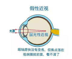 武汉胡靖中医诊所：家长疯抢的“神奇眼药水”真的能治近视？