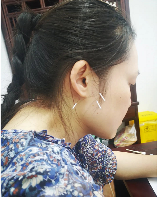 武汉和气执中中医诊所：邓锦超针灸治愈药物性耳聋