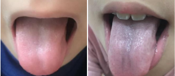 上海素问轩中医诊所：最常见的6种小儿舌像，身体哪里出了问题？！