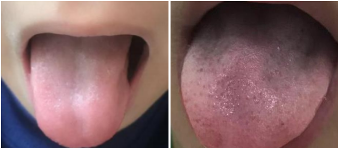 上海素问轩中医诊所：最常见的6种小儿舌像，身体哪里出了问题？！