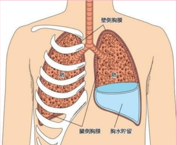 上海三爱中医：胸腔积液痛苦不已，中药治疗一切如常