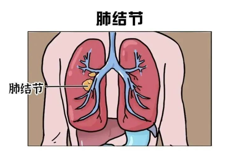 刘渡舟老亲传弟子韩世明——中药汤剂治肺结节