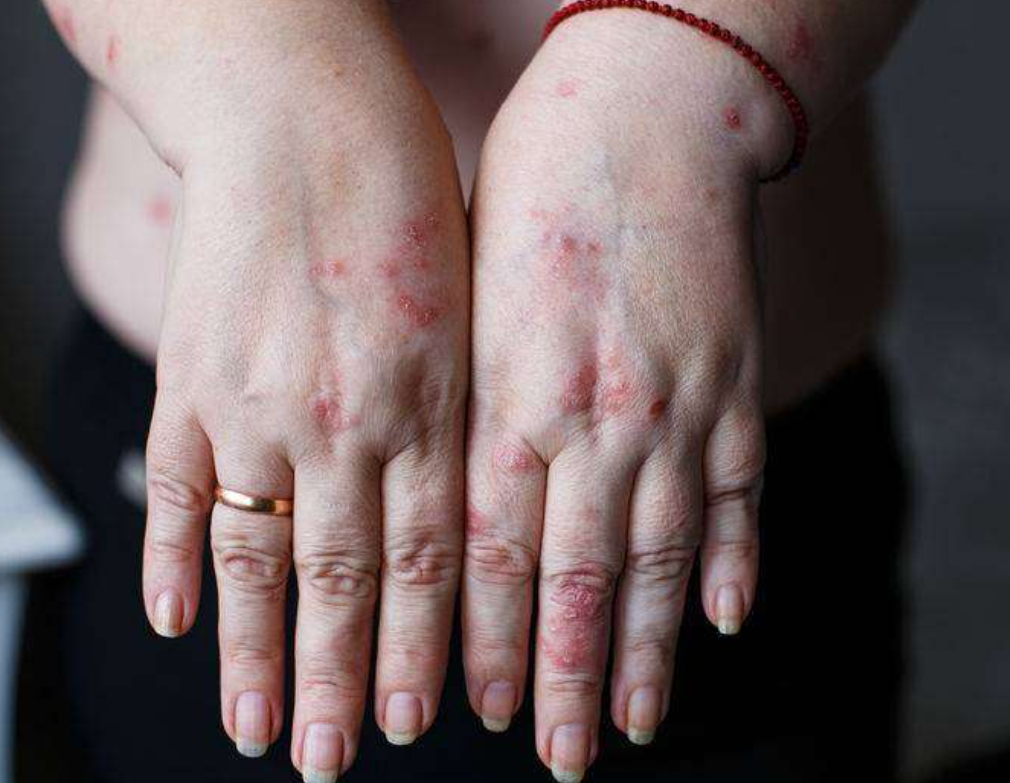 江西九江都昌县老科协中医馆：手上长汗疱疹，是身体的求救信号！