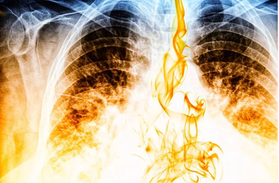 预防肺癌，远离“三霾五气”，早期发现是关键！