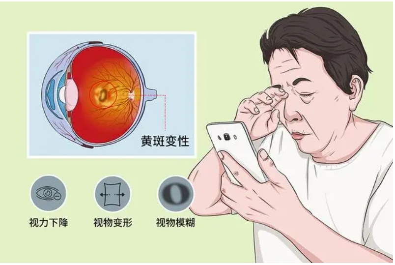 老年人眼睛视物不清，可能的疾病有哪些？