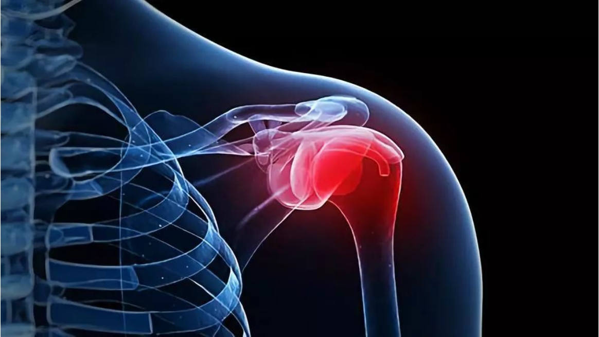 肩膀酸痛多半是肩周炎？提醒：是肩袖肌腱损伤的概率更大！